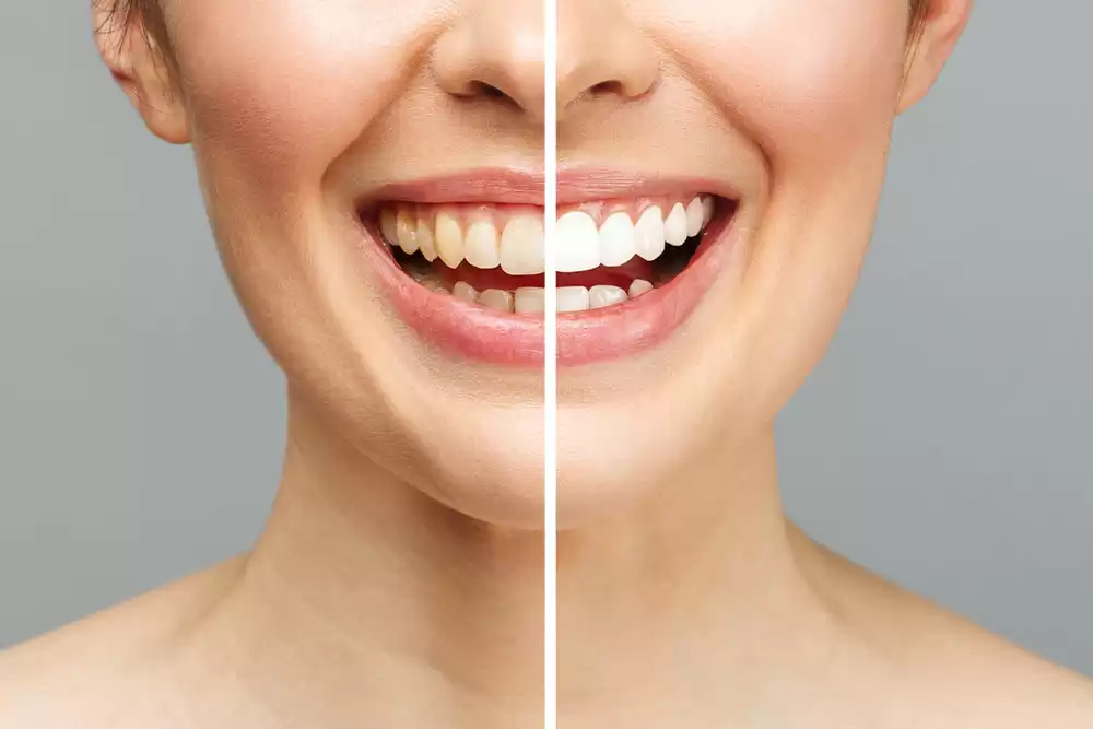 Teeth Whitening